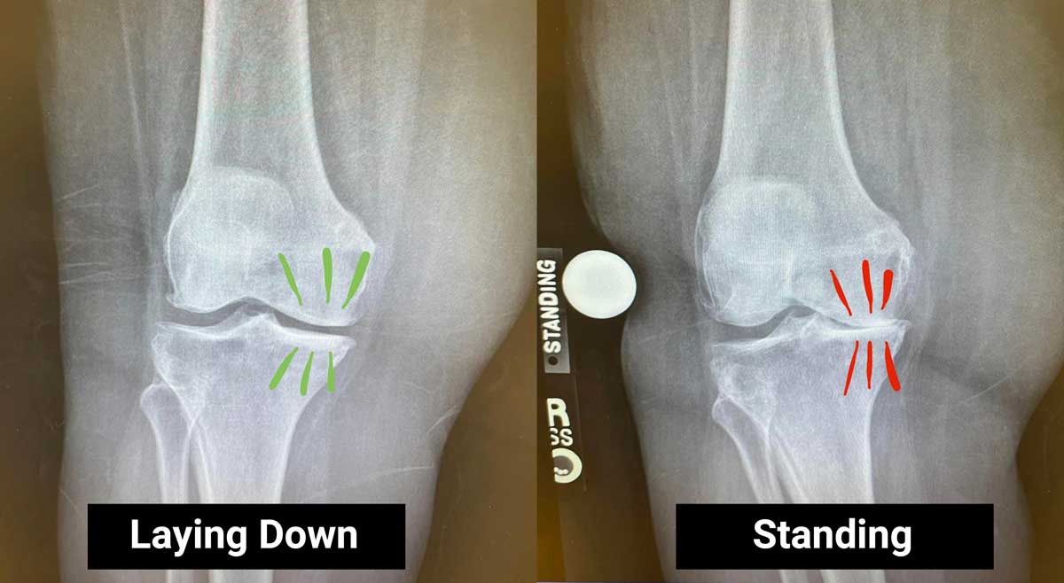X-ray comparison showing joint alignment and structure in laying down vs standing positions