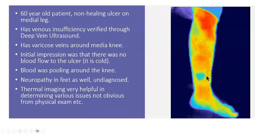 Thermal scan showing inflammation patterns in leg with case study details