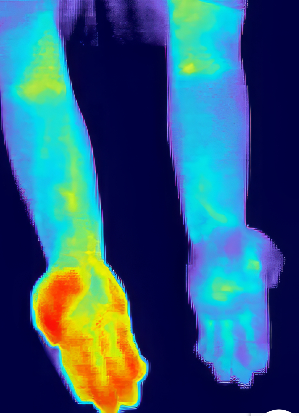 Thermal scan showing inflammation in foot and ankle